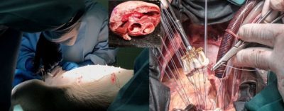 Pig Kidney Transplant to Human