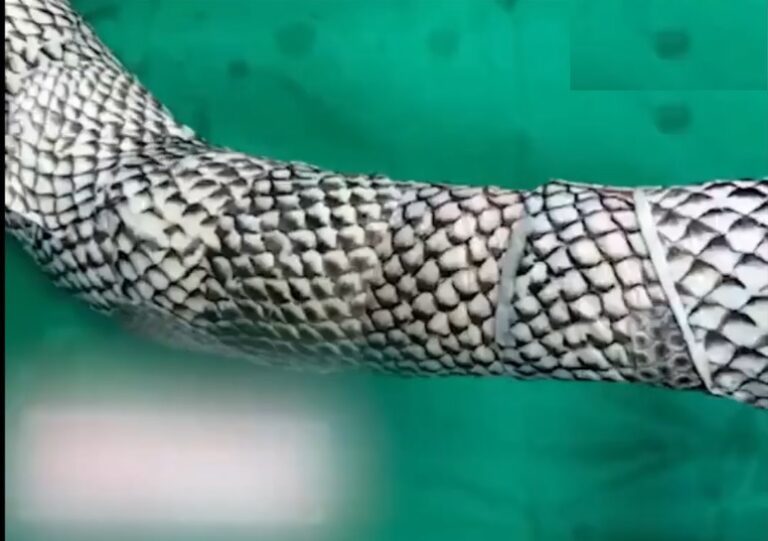 Gigadgets Unveils How Fish Skin Can be Used To Treat Skin Burn(Video