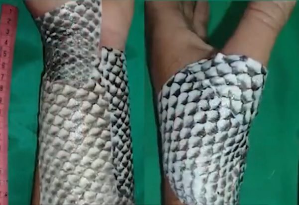 Gigadgets Unveils How Fish Skin Can be Used To Treat Skin Burn(Video)