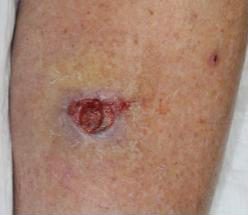  We Can Now Say Bye-bye To Bandages, Discover New Technology Heals Wounds Using Patient’s Blood